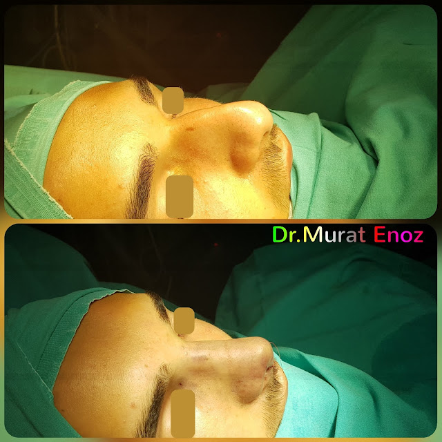 Male Nose Aesthetic Surgery in Turkey, Men's Rhinoplasty in Istanbul,Nose Job in Male Patient, Rhinoplasty in Men Istanbul,