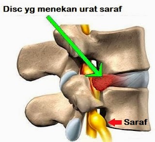 Tulang belakang :Bahaya 'slipped disc' ~ Natural Health 