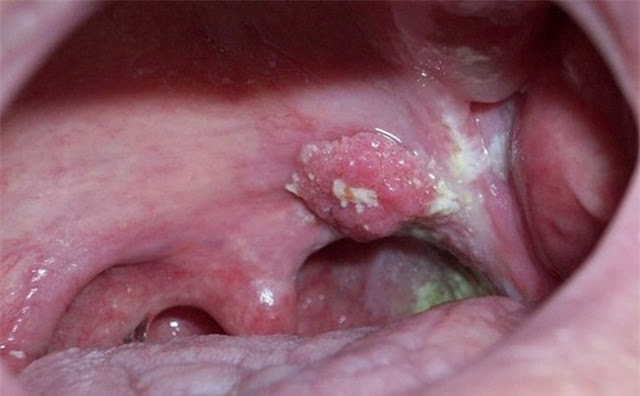 Viêm họng kéo dài dẫn đến ung thư vòm họng