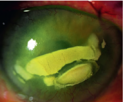 Bacterial corneal ulcer and its complication