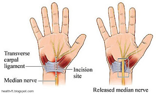 Relieving pressure on the median nerve