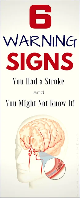 6 Signs You Had a Stroke (But You Might Not Know It!)