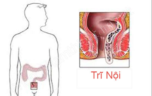 Bệnh trĩ nội có quá đau không