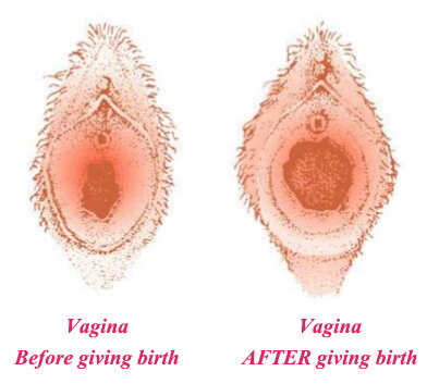 Global Vaginal Rejuvenation Treatment Market