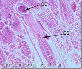 cacing tambang di usus besar