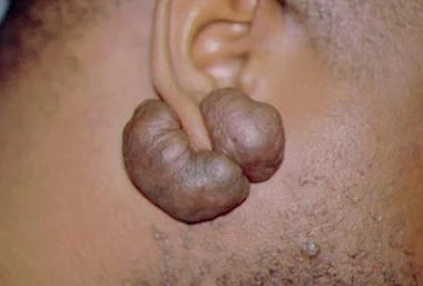 Herbal Solutions For Keloid