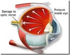 Ojo con glaucoma
