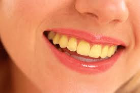Penyebab gigi menjadi kekuning-kuningan | widadaraharja.blogspot.com