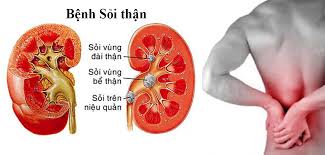 Nguyên nhân, triệu chứng và cách ngăn ngừa bệnh sỏi thận