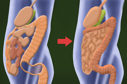 Remove 30 Pounds of Toxins from your Colon with Only 2 Ingredients