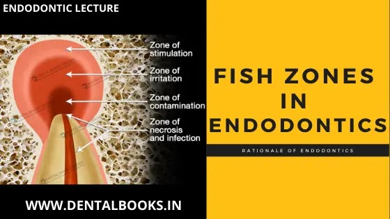 Fish Zones in Endodontic | Endodontic Lecture | Dental Notes