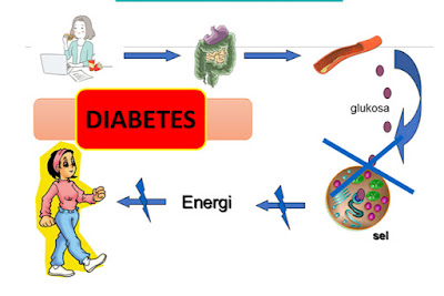 Diabetes Mellitus Dapat Terjadi Karena