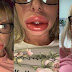 Réaction allergique: Ses lèvres doublent de volume après l’application d’un produit de beauté