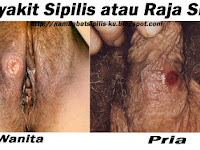 Obat Sipilis Pada Pria Yang Mujarab