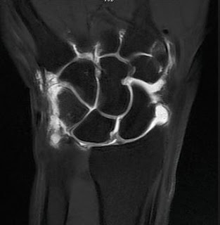 wrist arthrogram