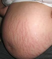 Mengurangkan Kemunculan Stretch Marks