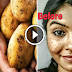 How To Remove Dark Spots Of Face In 7 Days!