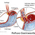 REFLUXO GASTROESOFÁGICO