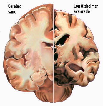 Los vasos sanguíneos están también afectados en la enfermedad de Alzheimer (Medicina)