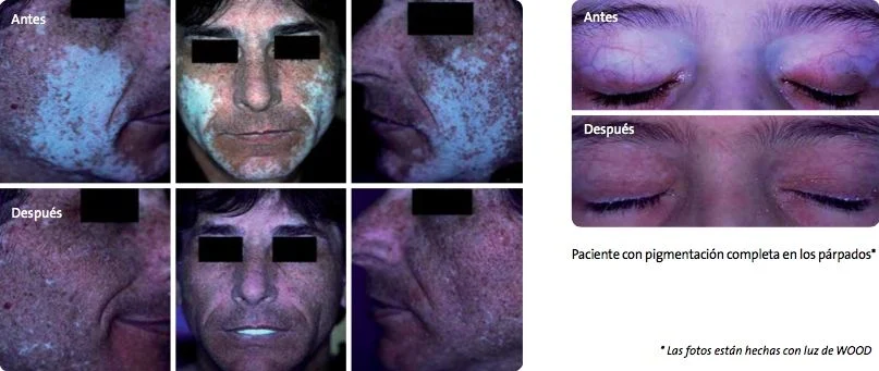 Vitiligo y Pigmerise, Resultados del estudio grupo B