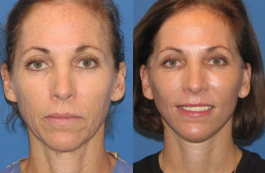 Cosmetic Laser Treatment by Dr. Paul Chasan