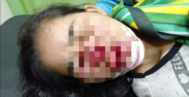 Orang Utan terkam dan Lukai Mulut dan Wajah Gadis Penjaga Durian di Aceh Timur