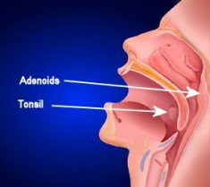 Penyebab Penyakit Sinusitis