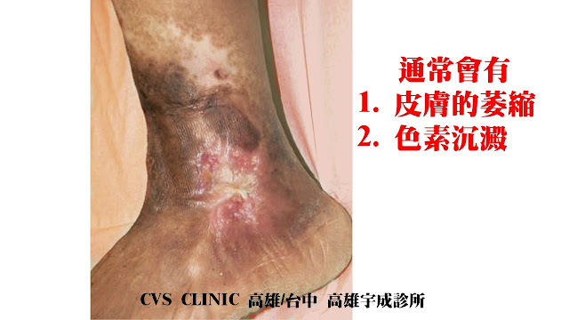 靜脈曲張伴隨已癒合傷口, varicose veins with healed ulceration wound