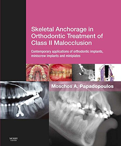 Skeletal Anchorage in Orthodontic Treatment of Class II Malocclusion cover