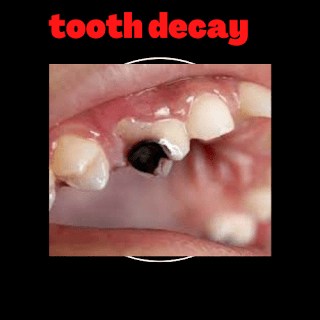 staphysagria homeopathic remedy for tooth pain