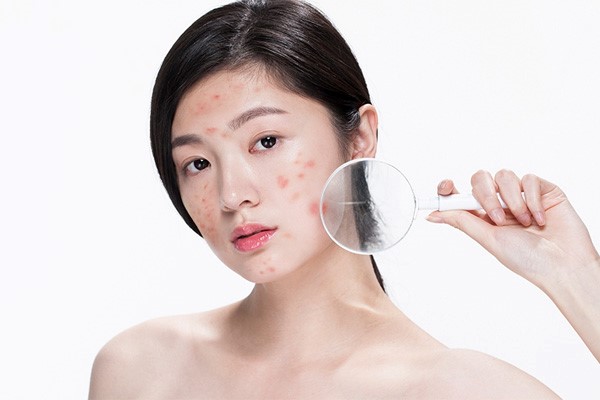 experts-reveal-the-mistake-that-makes-acne-worse-and-the-simple-solution