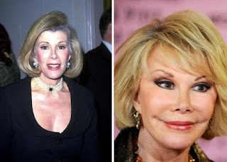 Kegagalan Operasi Plastik Joan Rivers