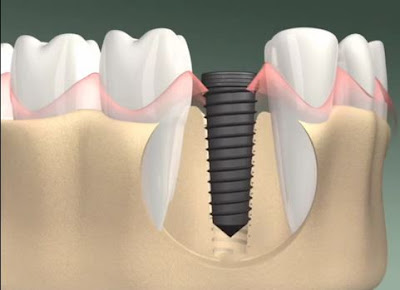 Lợi ích của việc trồng răng Implant cần chú ý