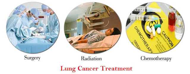 lung cancer treatment options