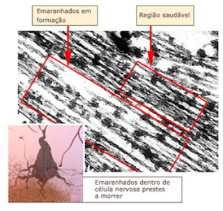 Esta imagem de um microscópio de elétrons mostra uma célula com algumas regiões saudáveis e outras regiões com formação de emaranhados.