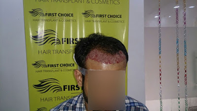 FCHTC hair transplant