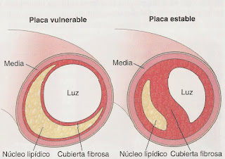   placa de ateroma, placa de ateroma formacion, ateroma calcificado, ateroma tratamiento, proceso de formacion de ateroma, como eliminar placas de ateroma, ateroma calcificado en aorta, sintomas de ateroma, ateroma aortico