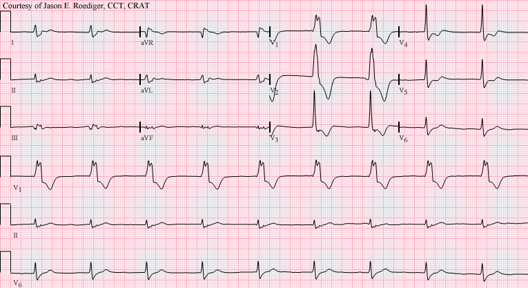 加速性心室自主節律 Accelerated idioventricular rhythm