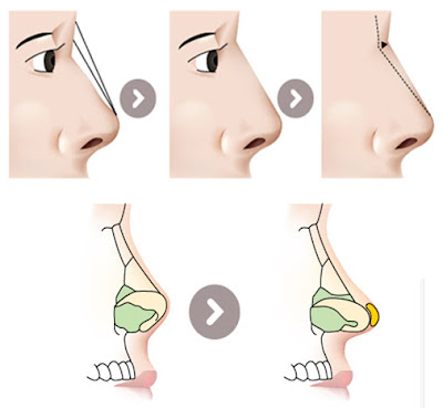 Nâng mũi không cần phẫu thuật là gì?