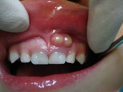 Dấu hiệu nhận biết viêm chân răng