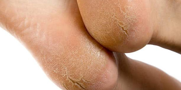 Cracked Heels Cause And Treatment - Health-Teachers