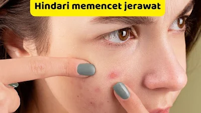 Hindari memencet jerawat.