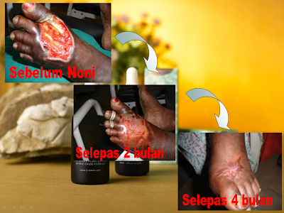 Enzyme Noni Mengkudu  Cancer  Stroke  Diabetes  High 