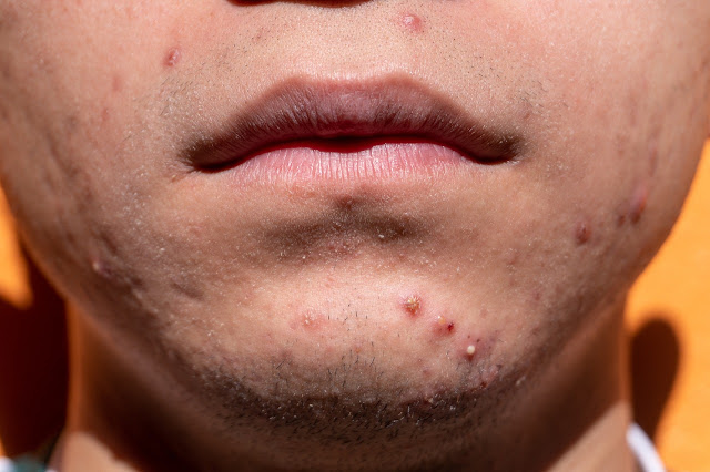 Acne skin dermatology image by yiyiphotos