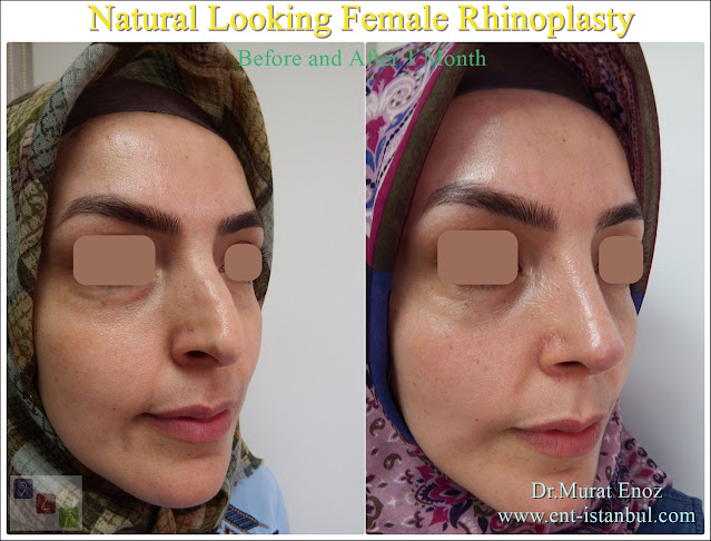 Natural rhinoplasty,Natural Nose Aesthetic Surgery,Natural Nose Job,Natural Looking Nose Operation,