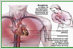 Penyebab Penyakit Jantung Koroner