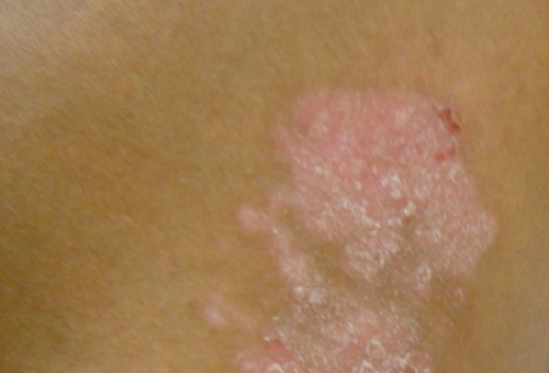 8 Penyakit Kulit Psoriasis Gejala Penyebab Cara Mengatasi