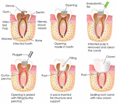 endodontist in dubai