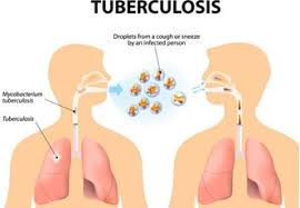 Everything about tuberculosis