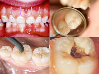 Trám răng - Phương pháp bảo vệ sức khỏe răng miệng